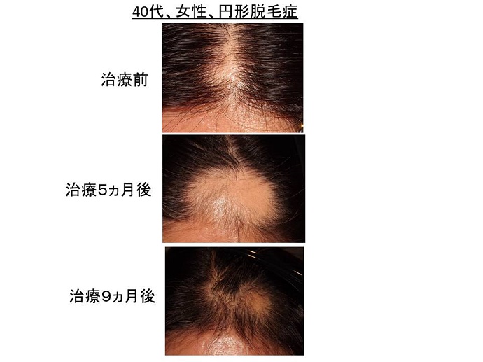 円形脱毛症　病院""